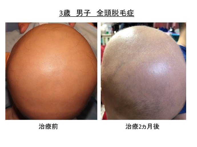 円形脱毛症　病院""